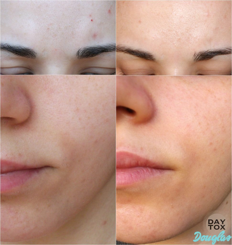 Daytox-by-Douglas-daytox-anti-age-skin-care-program-before-after-result-risultati-Valentina-Chirico copy